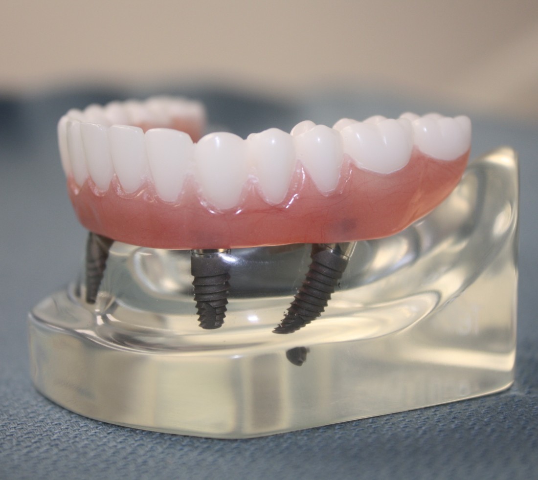 All-On-4 Implant Treatment | Birmingham, AL | WISE Oral - fixed-bridge