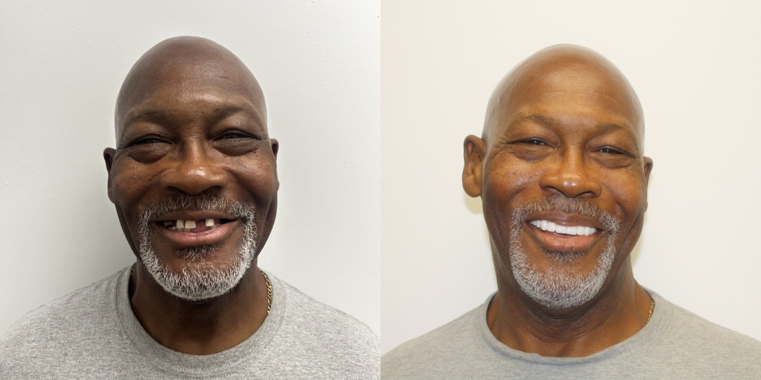 All-On-4 Implant Treatment | Birmingham, AL | WISE Oral - scott-before-after